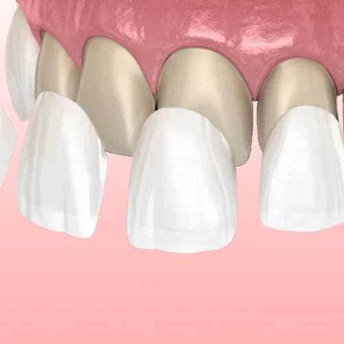 Faccette Dentali
